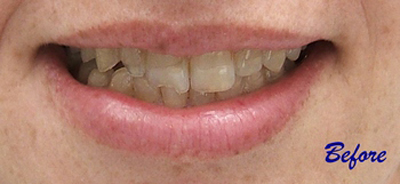 Close up of before image of teeth at Karl Hoffman Dentistry in Lacey, WA
