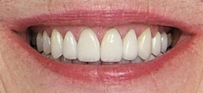 Close up of teeth at Karl Hoffman Dentistry in Lacey, WA