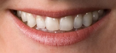 Close up of patient's teeth at Karl Hoffman Dentistry in Lacey, WA