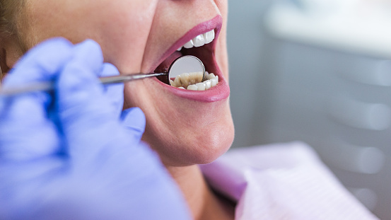 Close up of dentist examining a patient's mouth with a dental mirror at Karl Hoffman Dentistry in Lacey, WA