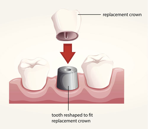 Diagram of dental crowns with varying placement at Karl Hoffman Dentistry in Lacey, WA