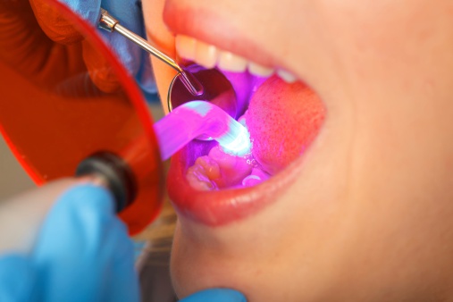 Dentist working with dental polymerization lamp in oral cavity at Karl Hoffman Dentistry in Lacey, WA