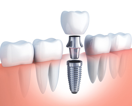 Single tooth implant in row of teeth at Karl Hoffman Dentistry in Lacey, WA Single tooth implant in row of teeth at Karl Hoffman Dentistry in Lacey, WA