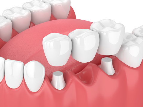 Dental bridge being placed in diagram of lower teeth at Karl Hoffman Dentistry in Lacey, WA