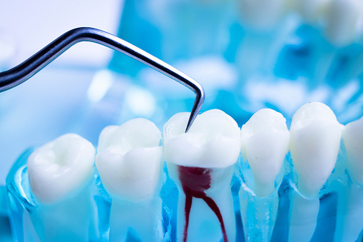 A model of teeth cleaning with titanium metal tooth pick instrument at Karl Hoffman Dentistry in Lacey, WA