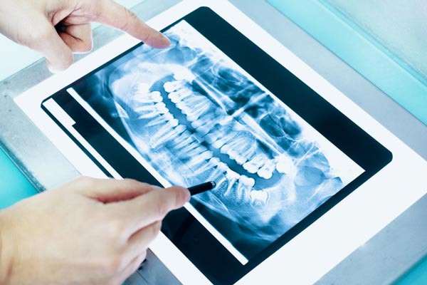 Dental x-ray of a full mouth at Karl Hoffman Dentistry in Lacey, WA