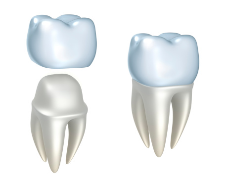 A dental crown above tooth and tooth with dental crown placed at Karl Hoffman Dentistry in Lacey, WA