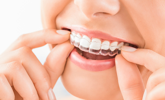 Close up of woman placing guard into mouth at Karl Hoffman Dentistry in Lacey, WA