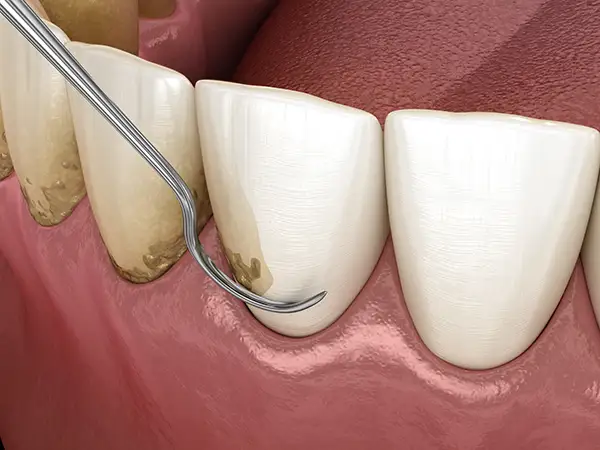 Close-up view of dental scaling and root planing to remove tartar buildup from the side of teeth illustrated by Karl Hoffman Dentistry in Lacey, WA