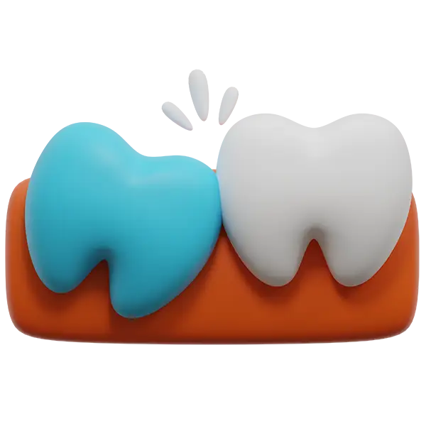 An inflamed wisdom tooth butting up against the healthy tooth next to it, highlighting the need for extraction.